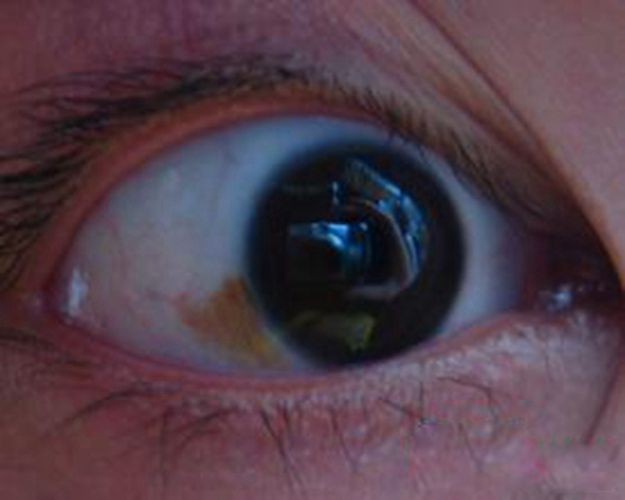 眼睛黄斑病人图片图片
