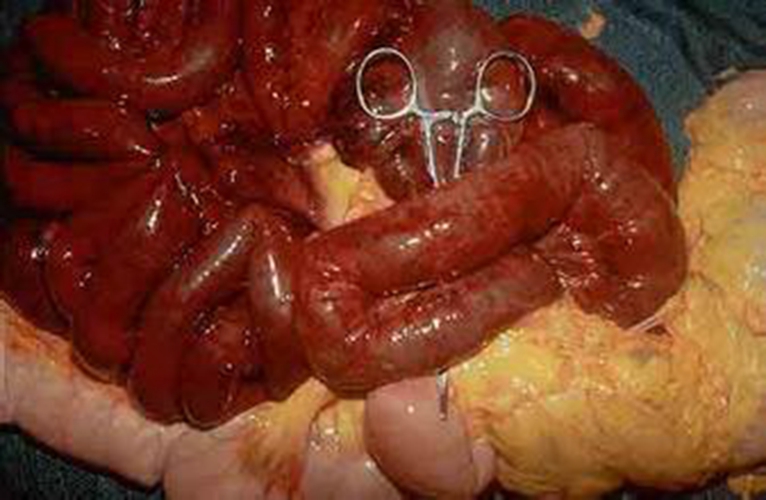 直肠癌的早期图片