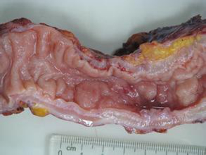 直肠腺癌早中晚期图片图片