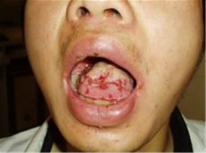 白塞病男子舌头症状图片