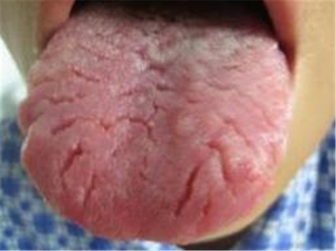 白塞病儿童舌苔位图片