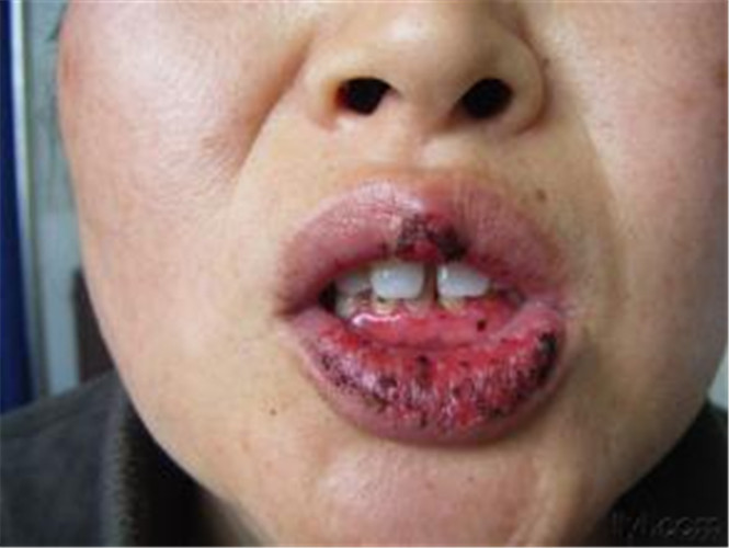 白塞病女患者嘴部图片