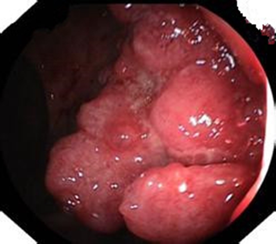 如何识别胃癌和大肠癌的早期症状图片