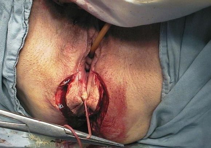 肛肠外科女性直肠癌切除实拍图片