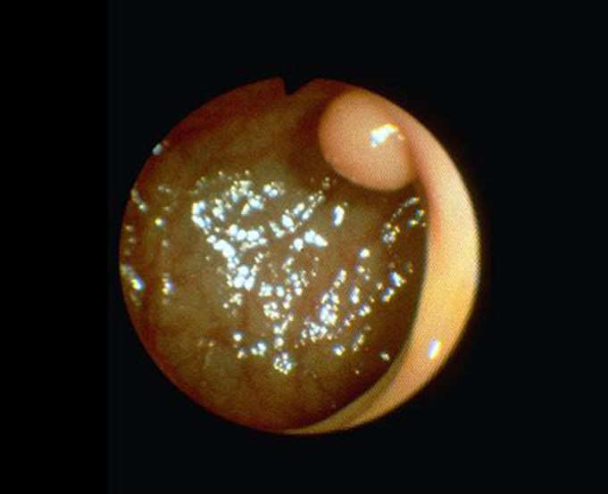 初期肠肿瘤观察肠镜图片