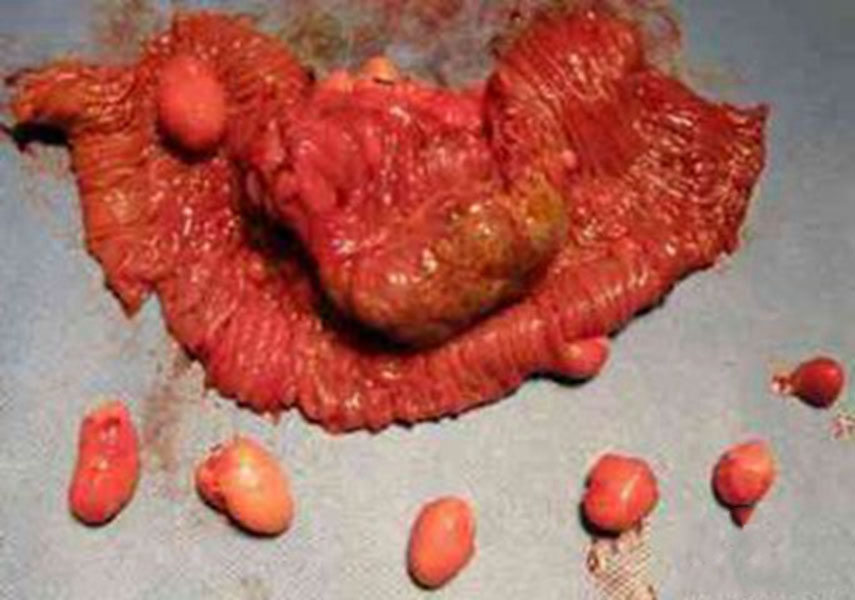 手术肠肿瘤术后图片