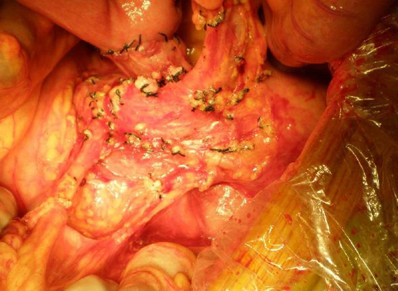 大肠肿瘤图片