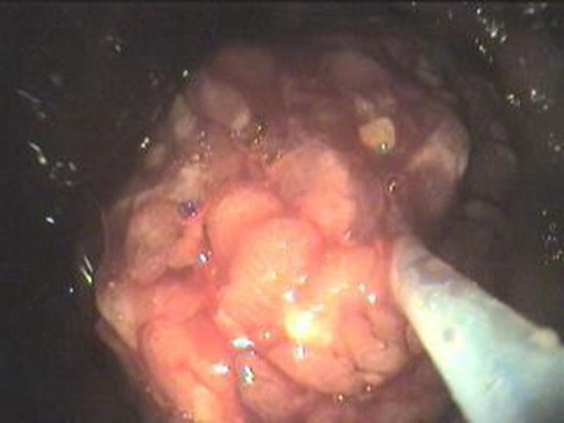 小肠癌图片