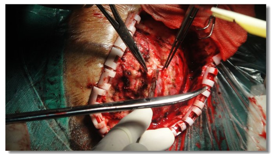 手术切除胶质瘤图片