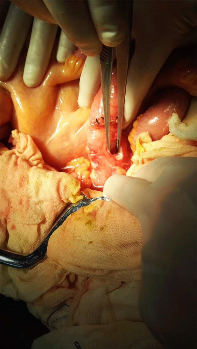 肠粘连并肠穿孔手术图片