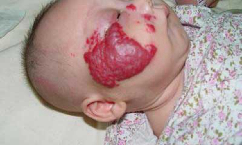 宝宝侧脸毛细血管瘤图片
