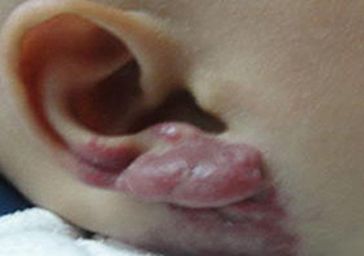 宝宝耳后毛细血管瘤有什么危害吗图片