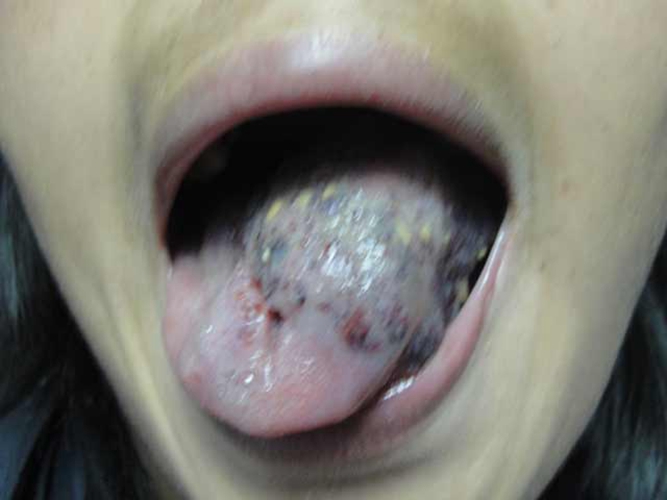舌部毛细血管瘤的症状及危害图片