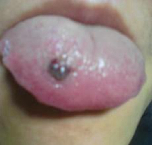舌头上毛细血管瘤有哪些症状图片
