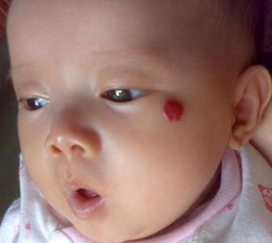 毛细血管瘤宝宝脸上的图片