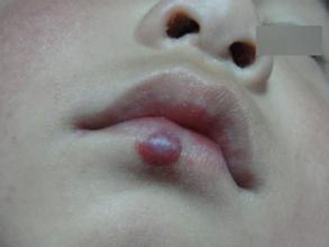 下嘴唇毛细血管瘤图片
