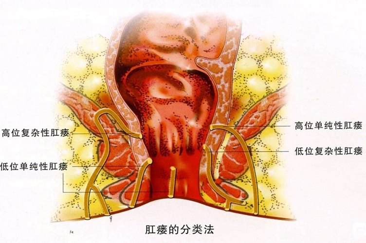 女性肛瘘单纯图片