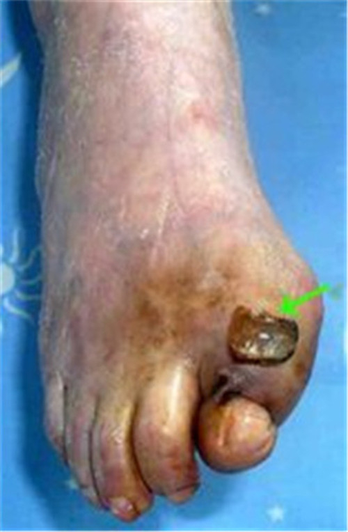 脚趾骨髓炎图片图片