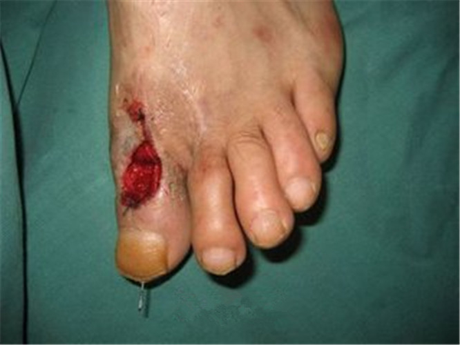 骨髓炎脚趾症状图片