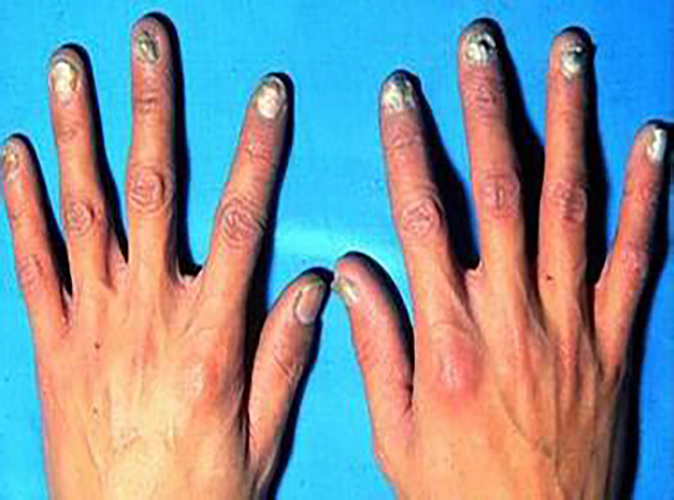 全手指甲营养不良症状图片