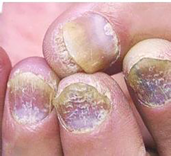 甲营养不良型灰指甲症状图片
