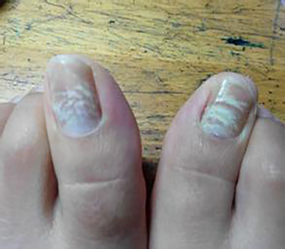 脚指甲营养不良的表现图片