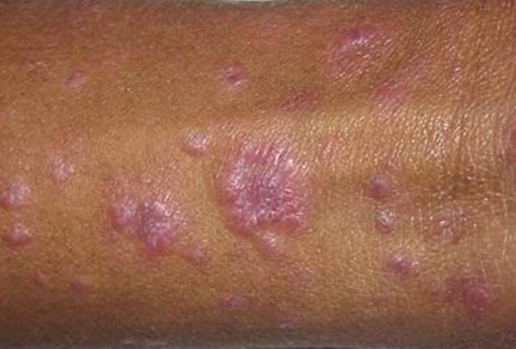 初期梅毒症状图片图片