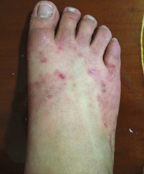 脚上起湿疹的症状图片图片