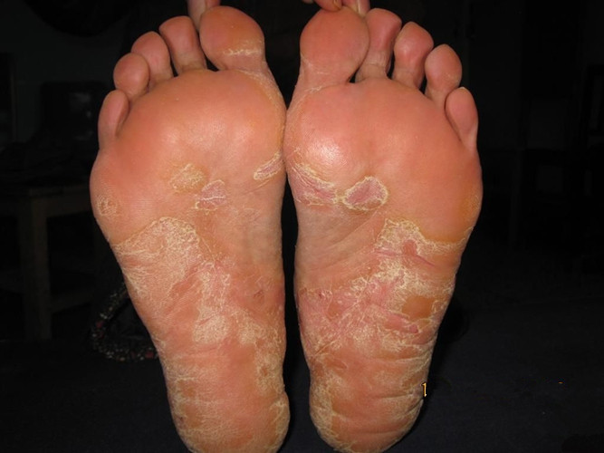 j525脚上慢性湿疹图片