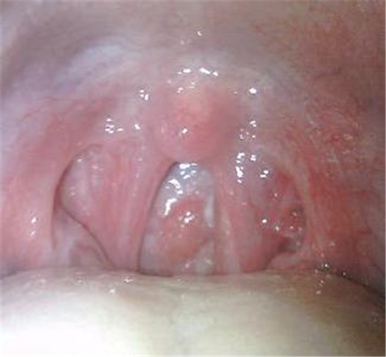 鼻咽炎的咽部图片