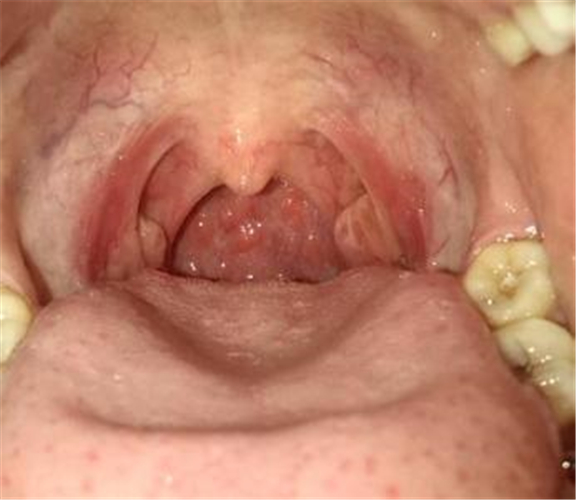 鼻咽炎口腔内的图片