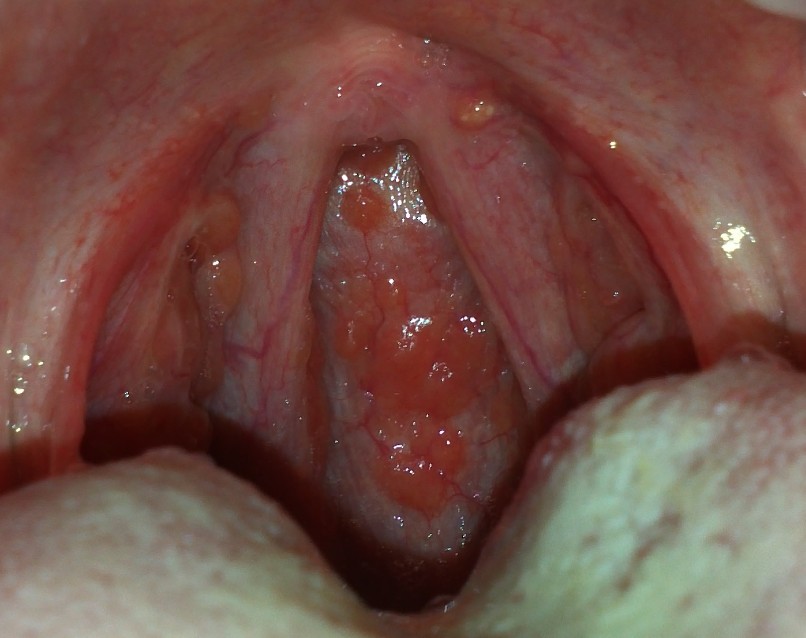 鼻咽炎咽部的局部图片