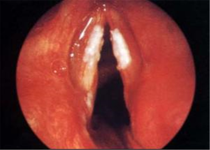鼻咽炎咽喉图片
