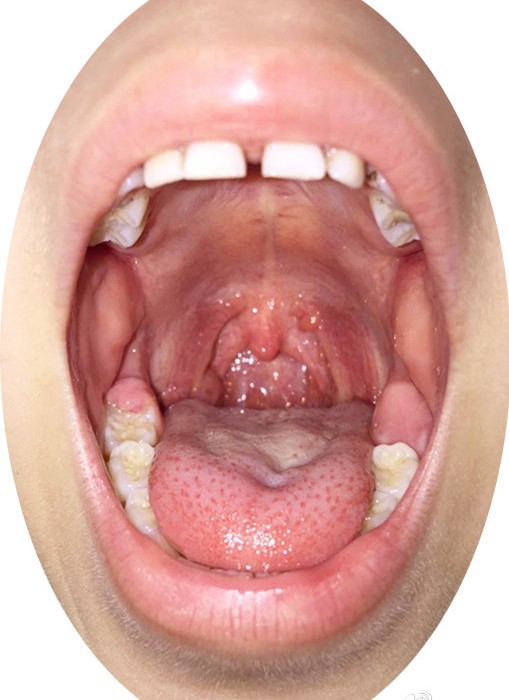 女性咽喉炎图片图片