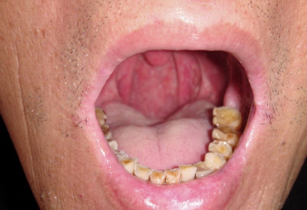 正常的咽喉炎图片图片