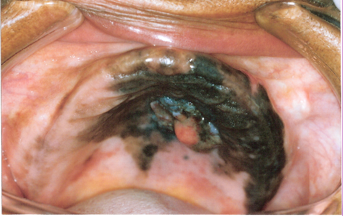 肛门黑色素瘤症状图片图片