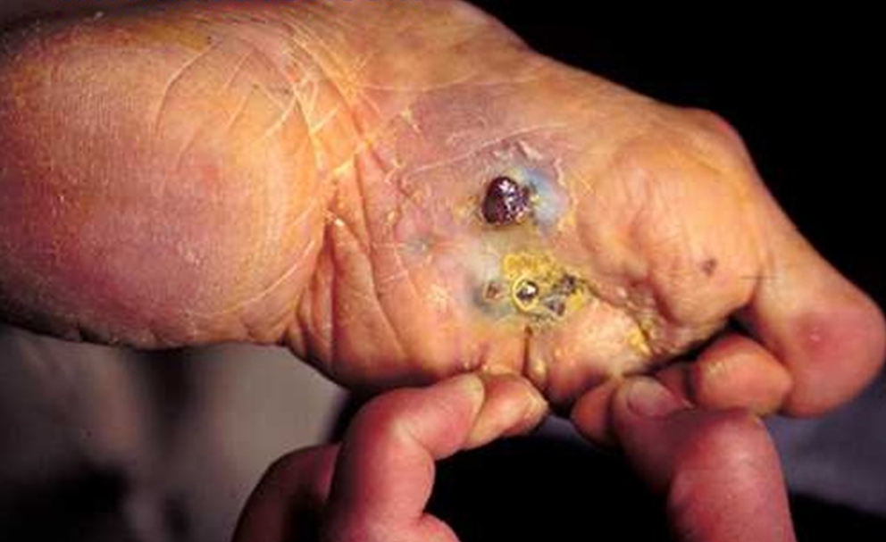 脚底恶性黑色素瘤照片图片