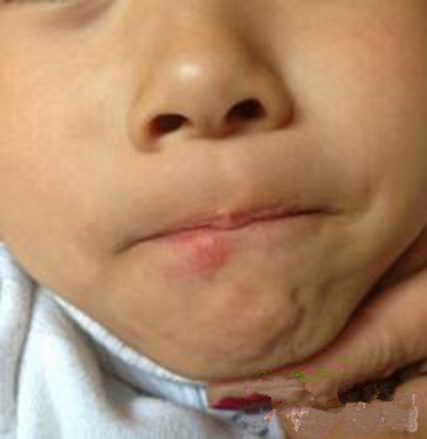 婴儿口唇疱疹图片
