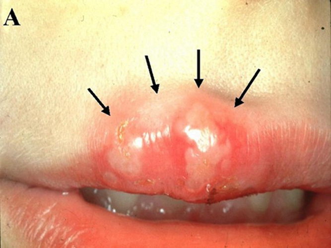唇疔疮的症状的照片图片