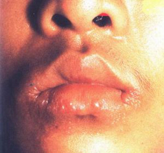 口唇下疳症状图片