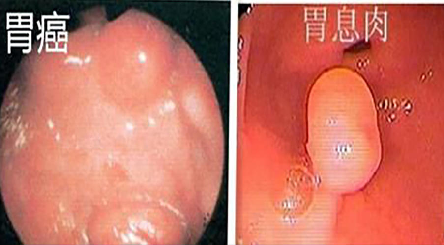 胃癌图片与胃息肉图片