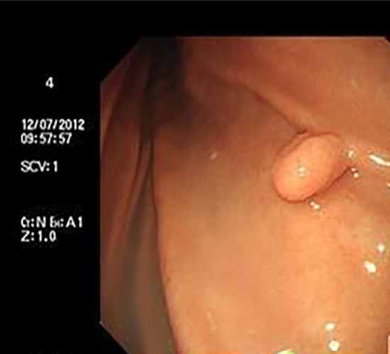 胃息肉手术后的表现图片