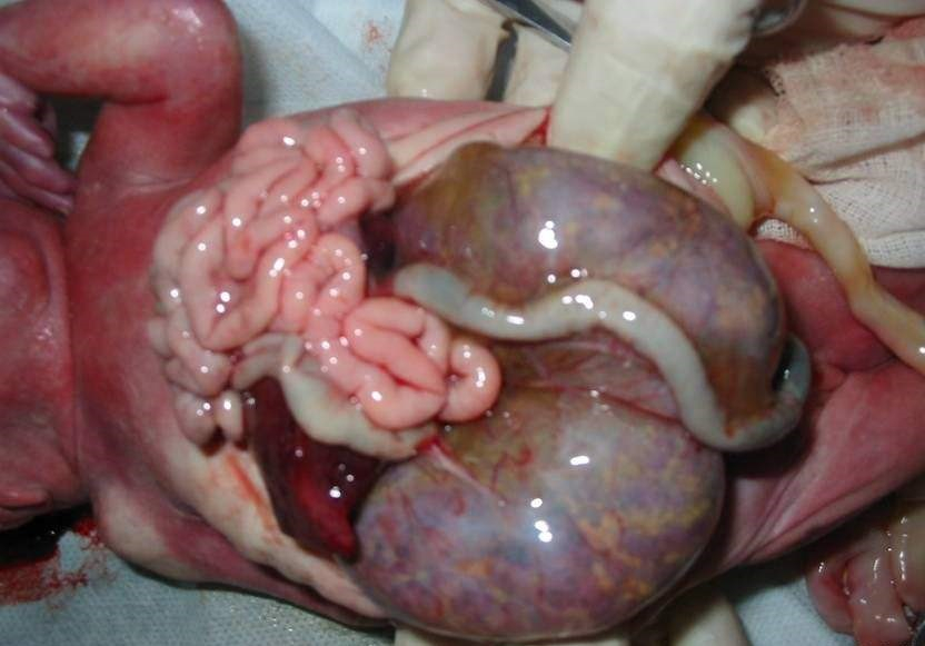 婴儿肾囊肿图片