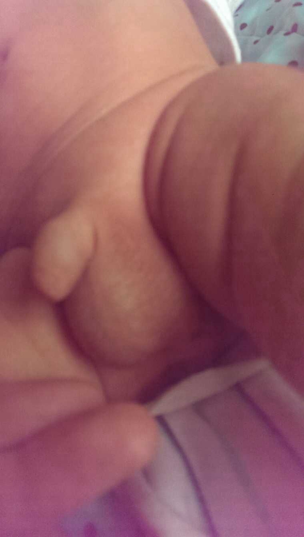 宝宝鞘膜积液的图片