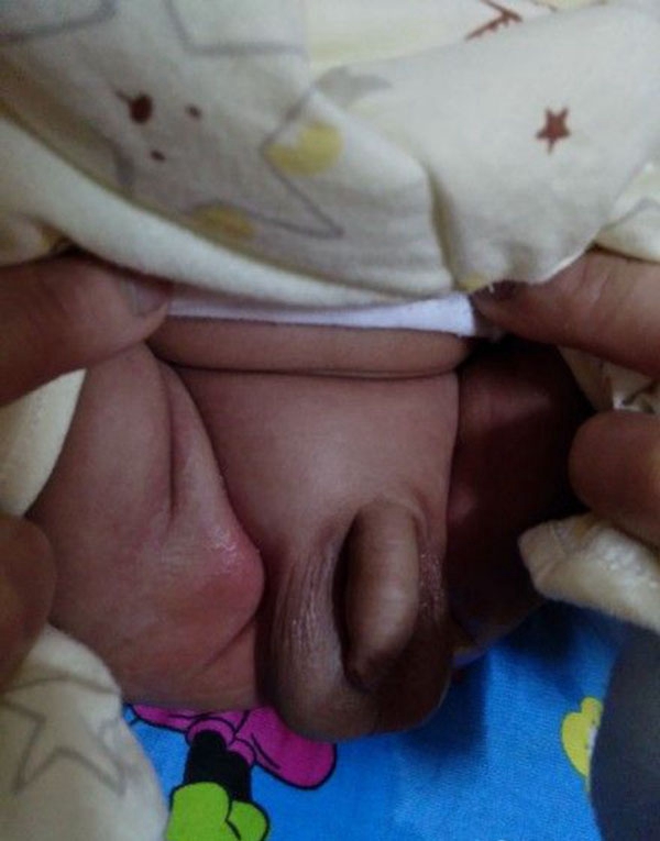 疾病鞘膜积液婴幼儿图片