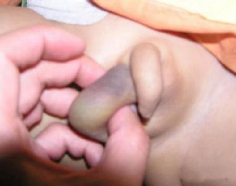 男婴鞘膜积液肿胀图片