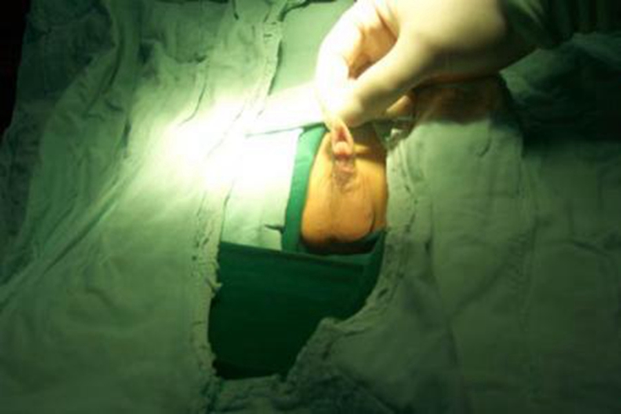 男婴鞘膜积液手术过程图片