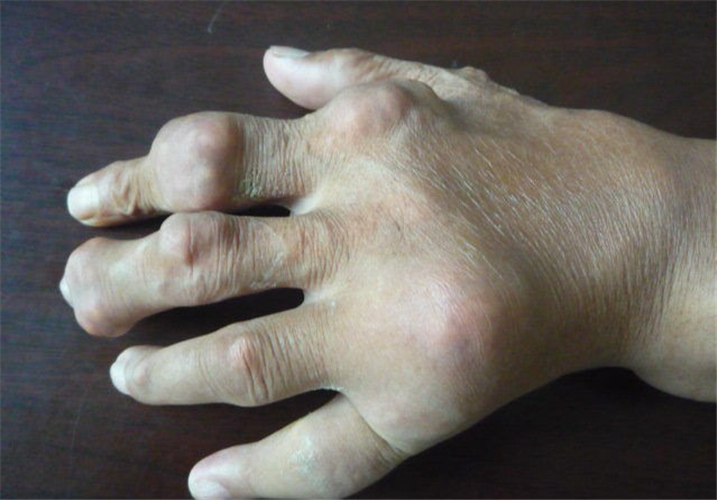 手关节痛风的症状图片图片