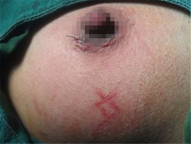 乳腺纤维瘤术后疤痕图片