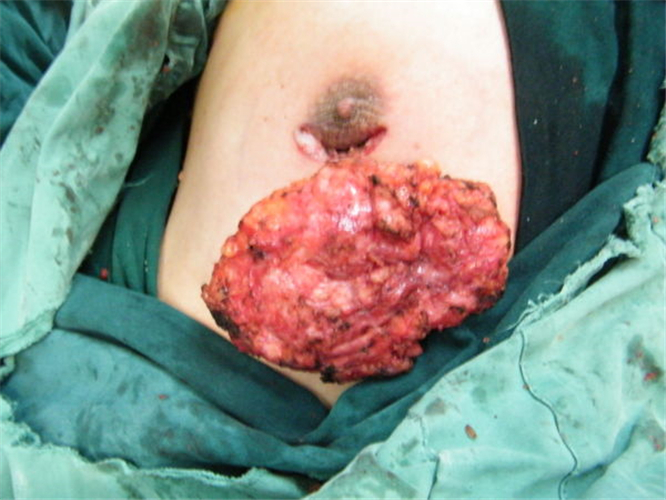 乳腺纤维瘤图片